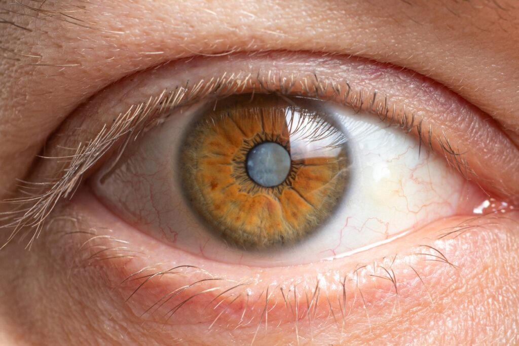 What to Expect Before, During, and After Cataracts Surgery